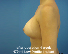 plastic-surgery-breast-augmentation